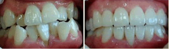 三個(gè)月前 牙齒擁擠的我找杭州美奧王明做了隱形牙齒矯正