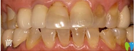 做瓷貼面美白前的四環(huán)素牙