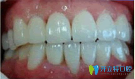 杭州美奧牙齒矯正三個(gè)月效果案例