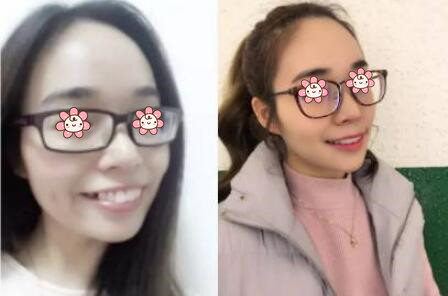 牙齒矯正后悔一輩子真相揭秘，那為什么有人30歲還矯正牙齒