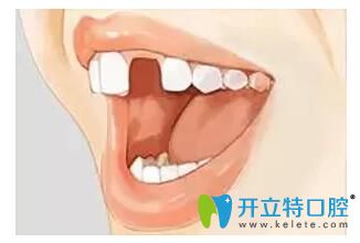 如果缺少了一顆牙 是選擇種植牙好還是烤瓷牙好呢？