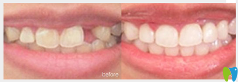 寧波牙博士口腔王道軍院長(zhǎng)種植牙案例效果圖