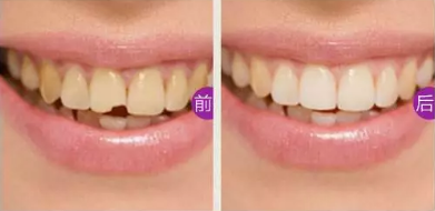 門牙缺損怎么辦？看湛江珠江口腔做嵌體修復(fù)后真假牙難辨