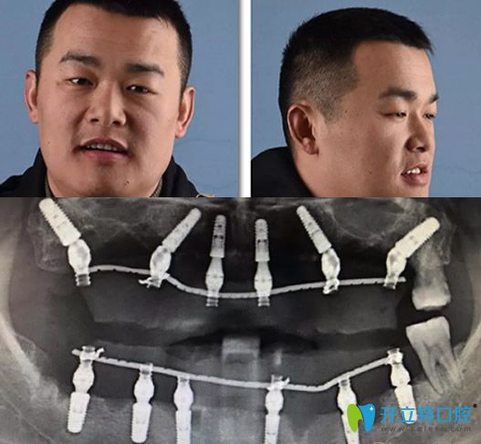 重慶牙博士徐孟輝種植牙術(shù)后即刻照片及修復(fù)后CBCT影像