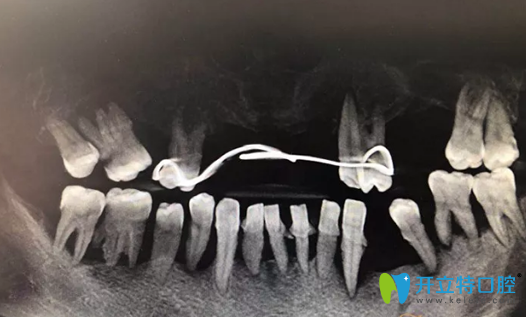 重慶牙博士種植修復(fù)前CBCT影像