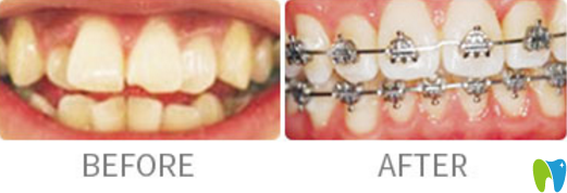牙齒矯正案例