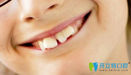 孩子牙齒不好哪個(gè)年齡段整牙好？3M隱形牙套還你整齊牙齒