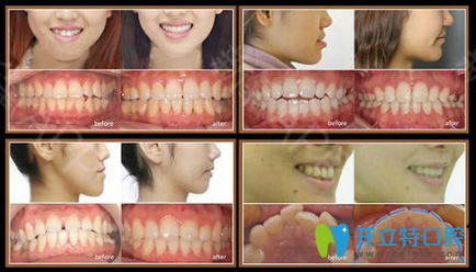 廣州瑞爾齒科中石化診所牙齒矯正案例圖 廣州瑞爾齒科中石化診所牙齒矯正案例圖