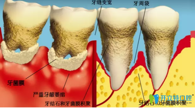 導(dǎo)致牙周病的原因