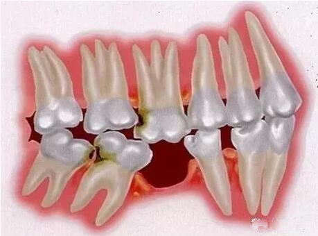 牙齒缺失了 這有三種修復(fù)手段哪種會(huì)比較好？