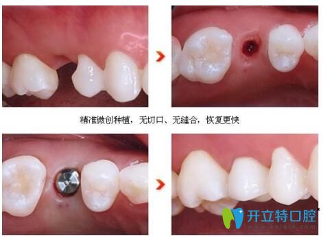 宿遷大眾口腔微創(chuàng)種植牙 安心種植新選擇！