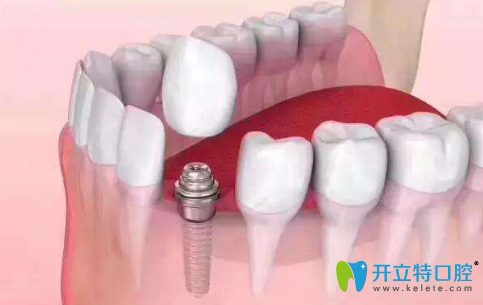 種植牙的方法