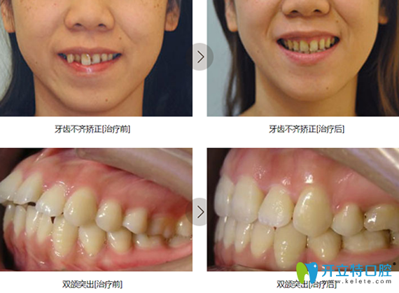 鎮(zhèn)江拜博口腔牙齒矯正前后對比照片