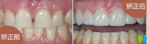 牙列稀疏、牙齒歪等矯正后效果對比圖