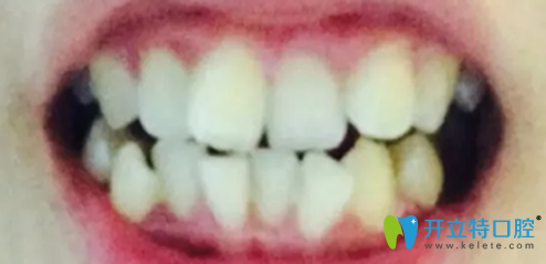 晉中潤芽口腔李智做牙齒擁擠矯正術前照