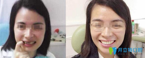 渭南小白兔口腔牙齒缺損+色素牙修復(fù)效果