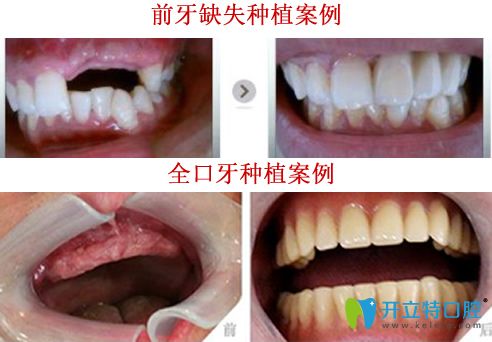 晉中潤芽口腔<!--<i data=20240703-sp></i>-->種植牙好嗎？看<!--<i data=20240703-sp></i>-->種植牙案例對比圖