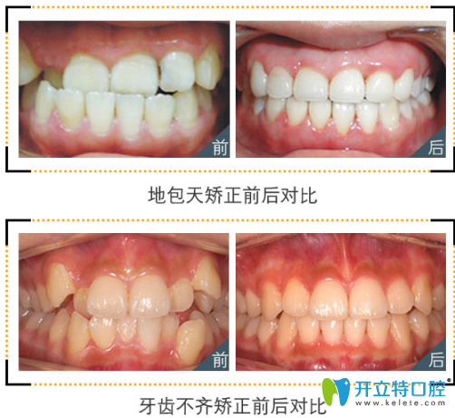 郴州植貝爾口腔牙齒矯正案例