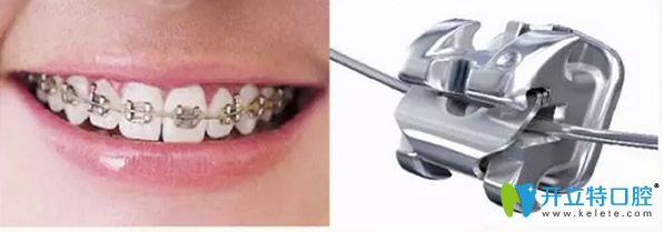 自鎖托槽矯正器