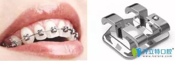 普通金屬托槽牙齒矯正