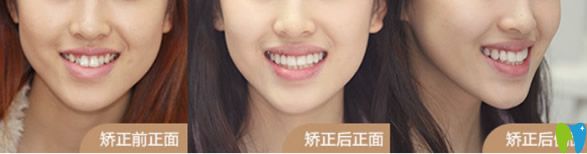 渭南小白兔口腔牙齒矯正案例