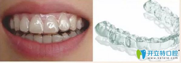 無托槽隱形矯正