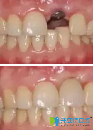 巴平妍醫(yī)師牙齒缺失修復(fù)案例
