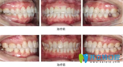 完全恢復(fù)之后我簡(jiǎn)直很開心，牙齒就這么完美了