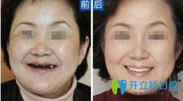 河源拜博牟啟蒙醫(yī)生全口種植牙案例