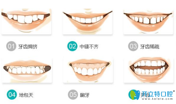 哪些情況牙齒需要矯正？牙齒矯正需要多少時(shí)間？
