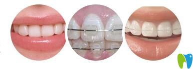 長沙美萊口腔青少年正畸矯正