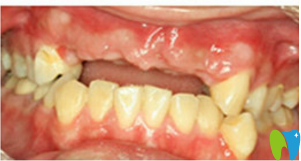 治療前口內(nèi)照