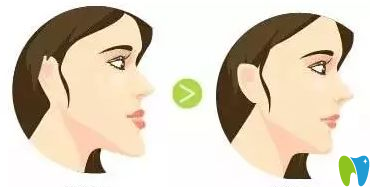 地包天如何預(yù)防？治療時(shí)間是什么時(shí)候？