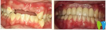 種植牙修復(fù)近照及對比效果
