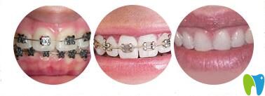 長沙美萊口腔兒童正畸矯正