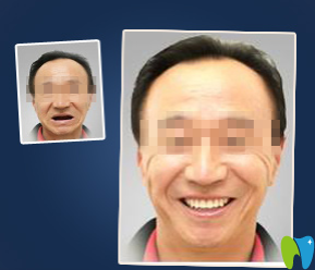 可恩口腔種植牙效果對(duì)比圖