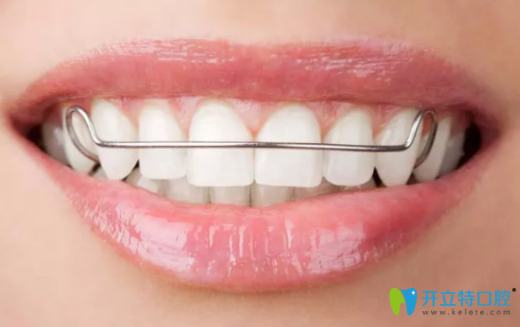 榆林長虹口腔牙齒矯正保持器