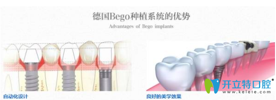 榆林長虹口德國種植牙系統(tǒng)優(yōu)勢 榆林長虹口德國種植牙系統(tǒng)優(yōu)勢