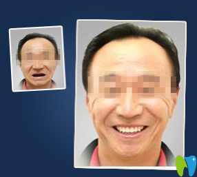 廈門宏沅膛口腔種植牙前后效果對比圖 廈門宏沅膛口腔種植牙前后效果對比圖