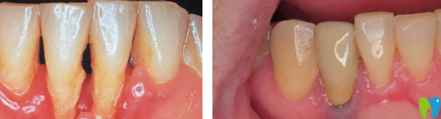 榆林長虹口德國種植牙系統(tǒng)案例 榆林長虹口德國種植牙系統(tǒng)案例