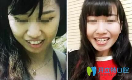 康美口腔牙齒矯正手術(shù)效果