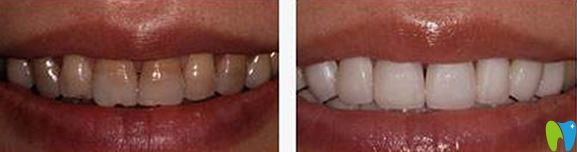 常州北極星口腔洗牙前后效果對(duì)比圖