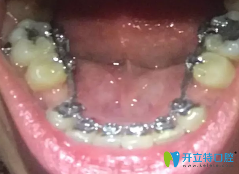 格倫菲爾（唐?。┛谇谎例X正畸1年后效果圖