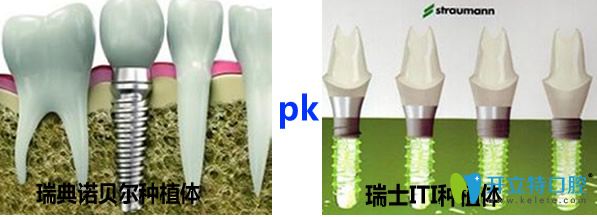 瑞典諾貝爾種植體和瑞士ITI種植體哪個好 種牙價格要多少錢