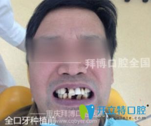 重慶拜博口腔牙齒種植前