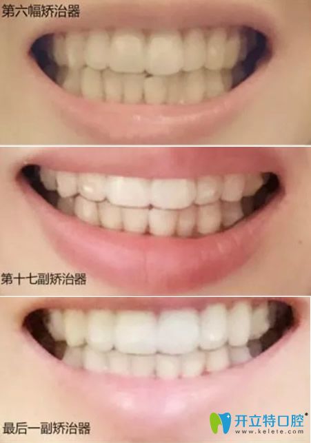 成都貝臣齒科牙齒矯正變化過程圖