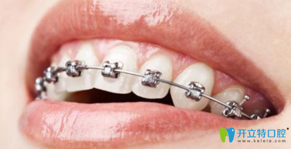 金屬托槽矯正是經(jīng)濟實惠的矯正方法