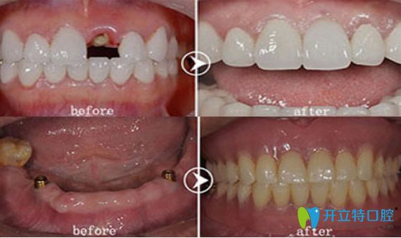 深圳愛康健口腔好不好？愛康健種植牙來證明