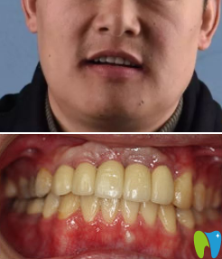 青島可恩口腔即刻種植牙術