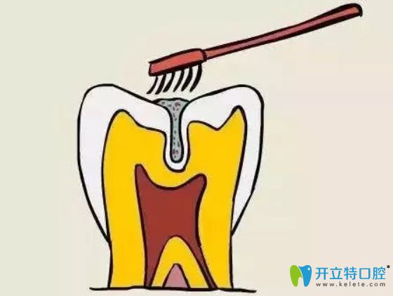 孩子幾歲做窩溝封閉合適？做完窩溝封閉后還會(huì)長蛀牙嗎？